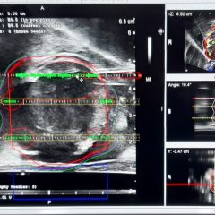 Un immagine dell'intervento di brachiterapia durante la fase di posizionamento dei semi radioattivi